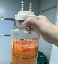 桂阳水动力吸脂手术要做多久？
